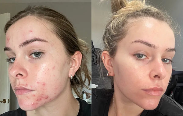 Acne result 1