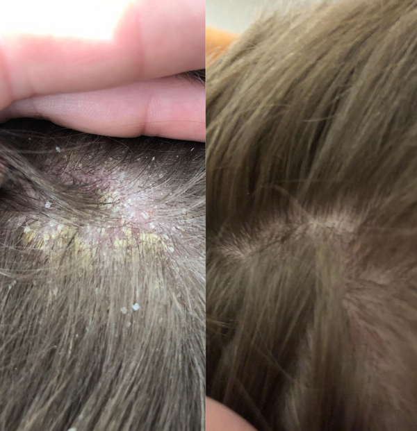Dandruff result 6