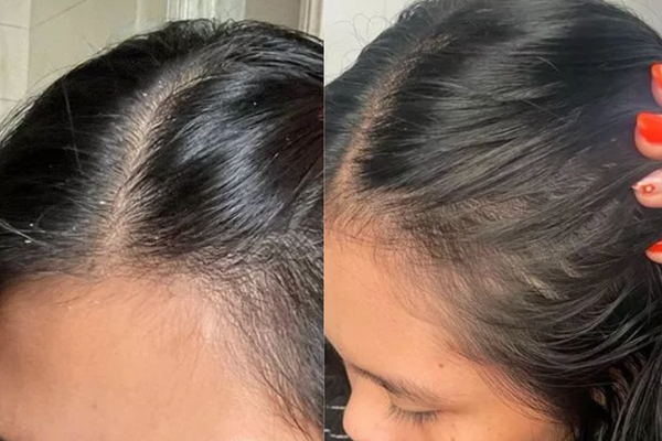 Dandruff result 3