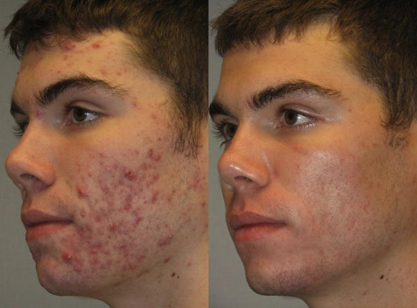 Acne result 3
