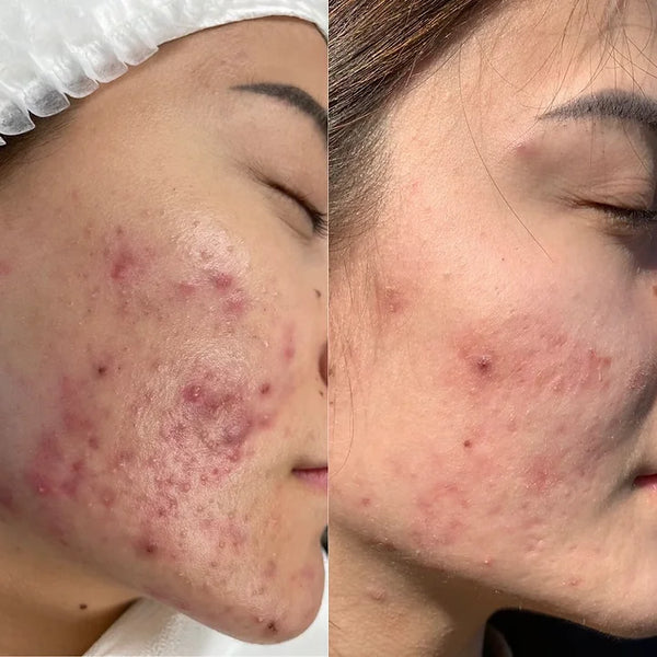 Acne result 5
