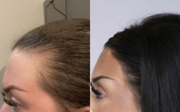 Hair shedding result 2