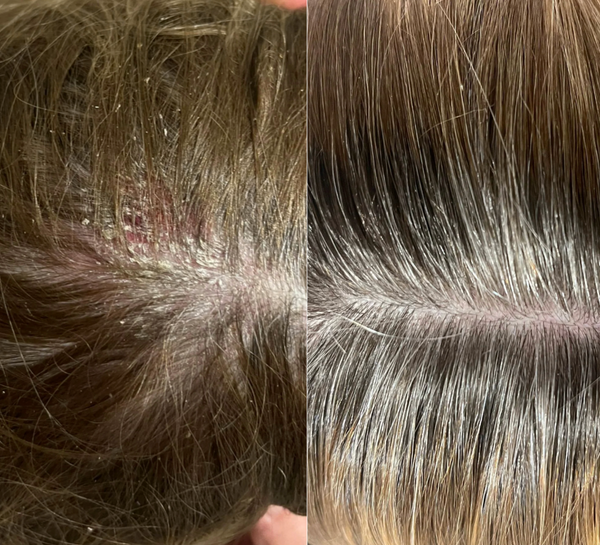 Dandruff result 4