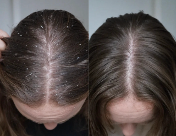 Dandruff result 5