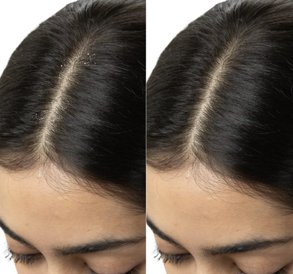 Dandruff result 1